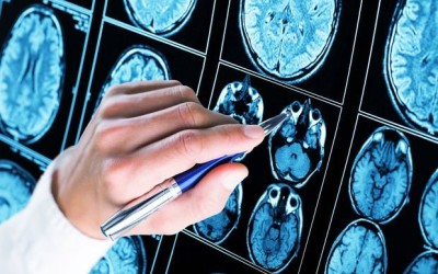 CBD and epilepsy. CBD and epilepsy.